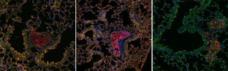 Células metastásicas de cáncer de mama (en rojo) anidando en nichos metastásicos en el pulmón. / Héctor Peinado, CNIO 