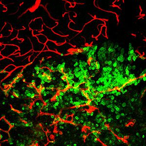 Imagen de una metástasis cerebral donde las células cancerígenas (en verde) están interactuando con los vasos sanguíneos (en rojo)./ CNIO