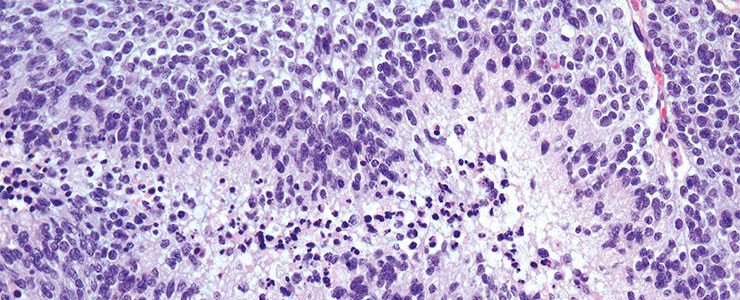 Histology of a glioblastoma induced by the silencing of RanBP6./ CNIO