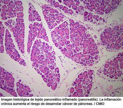 Imagen histológica de tejido pancreático inflamado (pancreatitis). La inflamación  crónica aumenta el riesgo de desarrollar cáncer de páncreas.