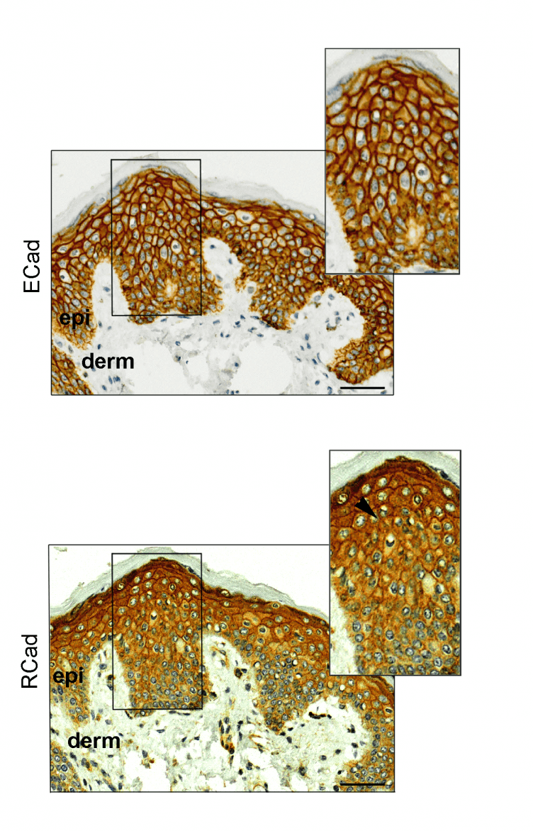 E-caderina and R-caderina in breast cancer