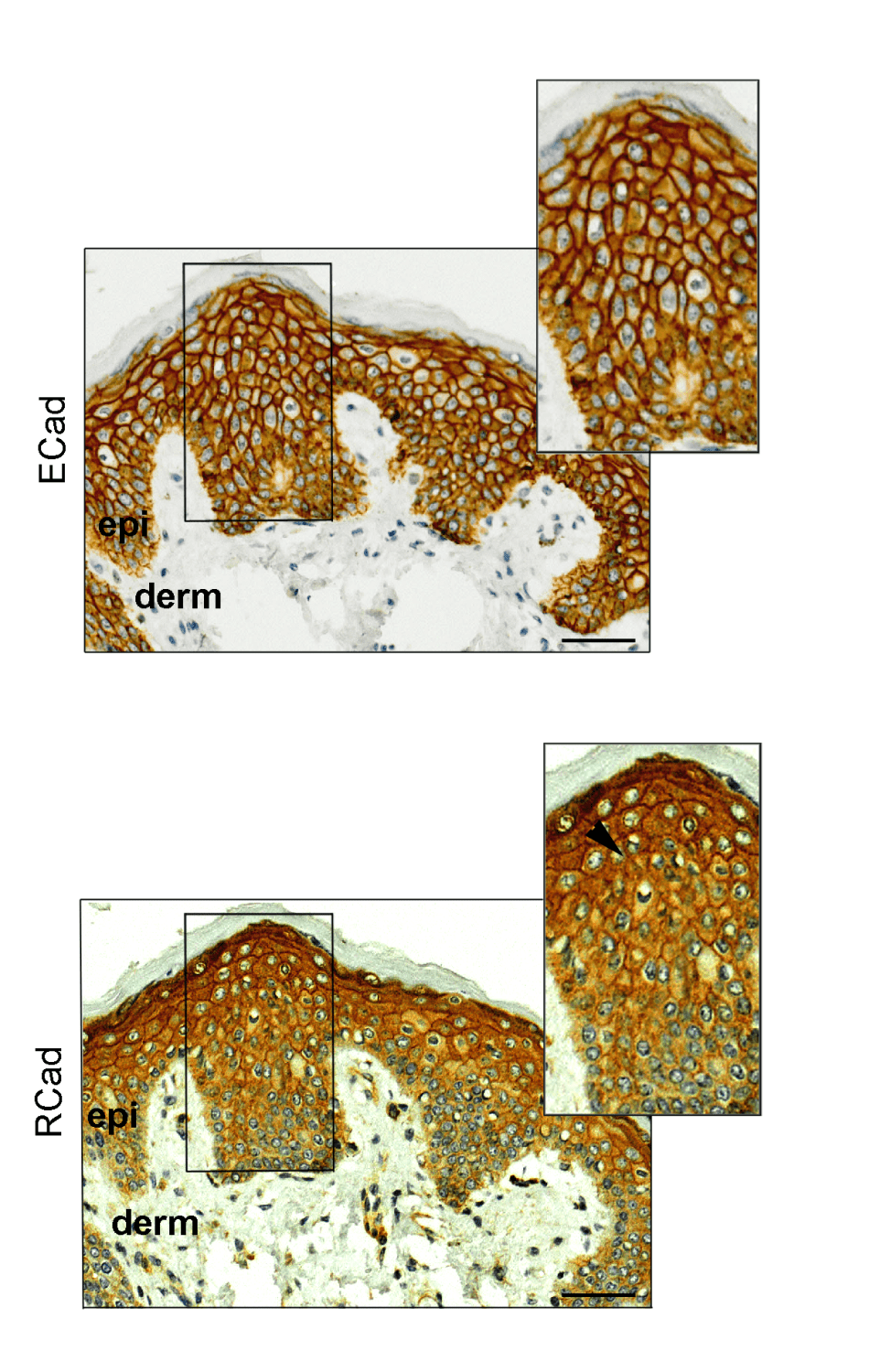 Análisis de inmunohistoquímica de E-caderina (ECad) y R-caderina (RCad) en muestras normales de piel obtenidos de pacientes con cáncer de mama antes del tratamiento con capecitabina. A diferencia de la proteína ECad (arriba), la proteína RCAD (abajo), se expresa mayoritariamente en las capas suprabasales de la epidermis que están implicadas en la aparición del síndrome mano-pie. <b>/CNIO</b>