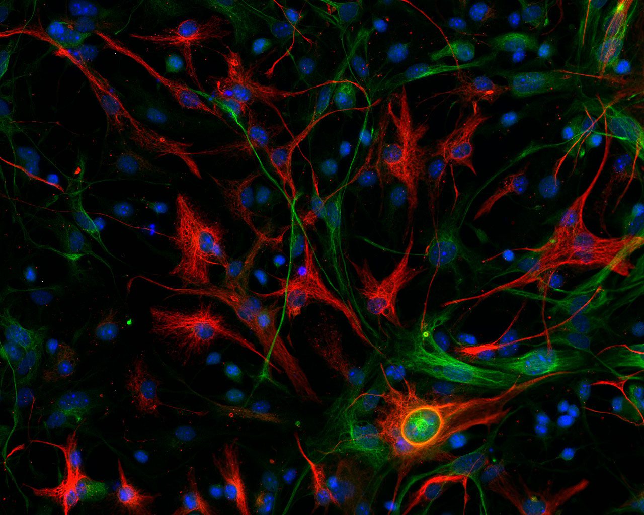 Mesenchymal glioblastoma in mouse models with stem cells marked green and cells differentiated in red. / CNIO