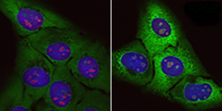 Acumulación de “proteínas basura”: Células normales (izquierda) y células sometidas al efecto de la proteína tóxica rica en arginina (derecha). En esta se incrementan las proteínas ribosomales (verde fluorescente) y el tamaño de los nucléolos (rojo). Crédito: CNIO.