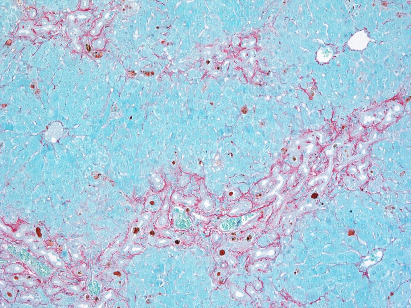 Fibrosis (rojo) en células del parénquima hepático (azul) como respuesta a una lesión celular. / Paula Sánchez. CNIO